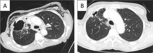 Evolution of Chest CT findings. A- CT at admission with a right upper lobe (RUL) cavitary lesion with a chest wall fistula. Extensive subcutaneous emphysema. B- CT after 2 months, revealing improvement of the lung cavitation and fistula on the RUL and no subcutaneous emphysema. The metastatic lesion submitted to thermal ablation is not present.