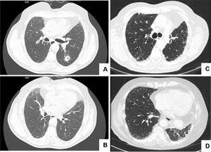 CT scans before and after left lower lobe lobectomy (LLL).Fig. 1A shows a 13 mm cavitated nodule in the LLL, posteriorly confirmed to correspond to a squamous cell lung carcinoma; no signs of interstitial lung disease were present in the lower lobes (Fig. 1B). Fig. 1C and D shows bilateral peripheric and basal reticulation and traction bronchiectasis in the inferior region, more evident in the left upper lobe, 21 months after LLL lobectomy.