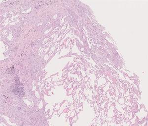 Histology of the cryobiopsy performed in the left upper lobe. At this magnification, normal alveolar tissue is surrounded by portions of alveoli replaced by irregular fibrous collagenous scars, with a predominantly paraseptal distribution. At higher magnifications, fibroblast foci were seen. The adjacent parenchyma has minimal interstitial inflammation. The aspects were compatible with usual interstitial pneumonia.