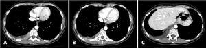 (A-C). Chest CT scan showing macronodular pleural thickening in lower half of right hemithorax with contrast hyperenhancement, associated to moderate right pleural effusion.