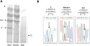 Characterization of ZQ0Leiria index case. (A) Protein gel electrophoresis. Index case ZQ0 displays only a band corresponding to PI*Z allele. (B) Electropherogram of the index case for SERPINA1 (NM_000295.5) exon 5, covering the mutations that define Z, Q0Leiria and M3 alleles. The arrows show the position of the corresponding nucleotide substitutions.
