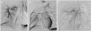 Angiography studies. (A) Pre-procedure selective right pulmonary angiography (B) shows the fusiform pseudoaneurysm of the middle lobe branch of the pulmonary artery. (C) Angiography post-procedure shows the complete embolization of the pseudoaneurysm with multiple detachable coils.