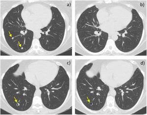 (a–d): Computed tomography axial images at middle (a, b) and lower lung (c, d) before (a, c) and after hysterectomy (b, d). The patient presented multiple bilateral well-defined and non-calcified lung nodules with a centrilobular distribution (arrows in a; nodules on the left not shown). During follow-up, nodules varied in size, and some developed cavitation (arrow in c). There was no interstitial lung disease, cystic lesions, pleural effusion, or mediastinal lymphadenopathy. After hysterectomy, some nodules completely disappeared (b) and cavitated nodules lost their solid component (arrow in d).