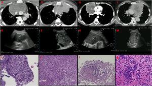 Computed tomography, ultrasound image and corresponding histology of 4 cases of US-NAB of anterior mediastinal masses expression of diffuse large B-cell lymphoma (panels A-C and D-F), undifferentiated epithelial malignancy with massive necrotic component (panels G-I) and primary thymic neuroendocrine tumor (panels L-N).