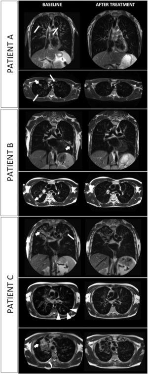 MRI scans of three consecutive patients (A. 18-y-o boy; B. 17-y-o boy; C. 35 y-o man); T2-weighted images on coronal and axial plane are shown. Evolution of most common lung alterations before (left column) and after (right column) initiation of treatment with elexacaftor-tezacaftor-ivacaftor. In every scenario lung consolidation either drastically decreased in extension or completely resolved. Bronchial wall thickening is widely reduced. Tree-in-bud nodules and pleural effusion disappeared (shown in patient C). Bronchiectasis are unchanged in extent and size. Fat arrow: parenchymal consolidation; thin arrow: bronchial wall thickening; arrow-head: tree-in-bud appearance; curved arrow: pleural effusion.