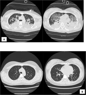 A/B: A) Chest CT-scan before ICU admission and pronation; bilateral pleural effusion, with bilateral diffuse consolidation areas and ground-glass opacities. B) Chest CT-scan at 36 h after ICU admission, with reduction of the consolidation pattern.