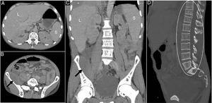 (A–D) Portal phase abdominal CT with intravenous contrast medium showing the liver (L) and spleen (S) without perceptible abnormalities, retroperitoneal collection near the iliopsoas muscle in the fossa (black arrow), diffuse changes in trabeculation and bone marrow density throughout the skeleton (white circle), as well as a mild to moderate pleural effusion at the base of the right hemithorax (*).