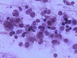 Bone marrow aspirate showing immature mast cells with bilobated nuclei and degranulated cytoplasm (x1000).