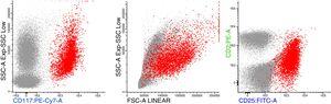 Multiparameter flow cytometry showing CD117 positive abnormal mast cells, with high size (FSC) and complexity (SSC) and positivity for CD25high and CD2dim.