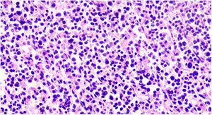 Splenectomy specimen with architectural effacement due infiltrating plasma cells. The neoplastic cells are CD138 positive (membrane).