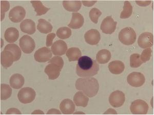 Peripheral blood smear examination revealing normocytic normochromic anemia with increased schistocytes, polychromatophilic red blood cells and thrombocytopenia, suggesting microangiopathic hemolytic anemia.