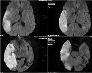 Brain MRI with venogram showing acute non-hemorrhagic infarct in the left parietooccipital region and the computed tomography (CT) venogram showed a subacute infarct in the left middle cerebral artery (MCA) territory.
