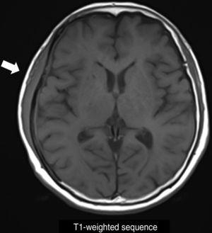 MRI showing a hypointense subdural lesion in the right temporoparietal region (arrow) on a T1-weighted sequence.