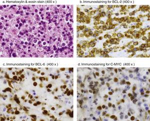 Neoplastic cells. (a). Hematoxylin & eosin stain (400×). (b). Immunostaining for BCL-2 (400×). (c). Immunostaining for BCL-6 (400×). (d). Immunostaining for C-MYC (400×).