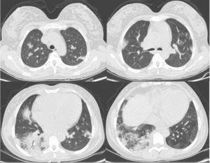 Patient's CT showed typical findings of SARS-CoV-2 infection: bilateral pulmonary parenchyma ground-glass and consolidative pulmonary opacities with peripheral lung distribution.