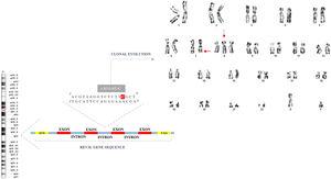 Next-generation sequencing showing REV3L gene mutation in MDS patient with clonal evolution. karyotype: 47, XY,+8[6]/47,XY,del(7)(q32),+8[7].