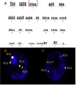 A, B and C–Cytogenetic studies from case 4: (4A) Lymph node karyotype analysis with G-banding demonstrating complex and hypotetraploidy karyotype, (4B) interphase break-apart FISH showing two extra copies of BCL6 (4 fusion signals) detected in paraffin-embedded tissue and (4C) in suspension cells.