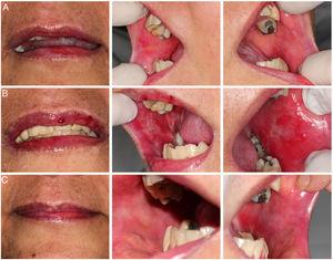 Clinical images: Line “A” baseline images showing classic cGVHD lesions; Line “B” clinical condition in acute complication of the oral mucosa; Line “C” D + 4 of treatment for Mycoplasma with doxycycline.