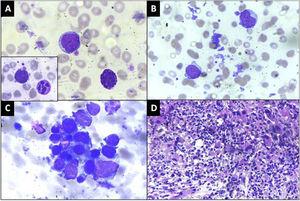 A: Peripheral blood smear showing a blast and a basophil. Red Blood cells in the background show moderate anisopoikilocytosis. Inset: A dysplastic hypersegmented neutrophil along with a blast (×1000, Giemsa), B: Blasts with cytoplasmic blebs and megakaryocytic fragments, (×1000, Giemsa) C: Bone marrow aspirate smear showing a cluster of dysplastic megakaryocytes and blasts (×1000, Giemsa), D: Trephine biopsy showing streaming and clusters of dysplastic megakaryocytes and megakaryoblasts (×400, Hematoxylin & eosin).