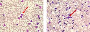 (A) Peripheral blood film (stained with Wright-Giemsa) demonstrates lymphocytosis with some lymphocytes exhibiting multilobulated appearance resembling flower-like appearance (red arrow). (B) Bone marrow aspiration (stained with May-Grunwald-Giemsa) is hypercellular for age and shows lymphocytosis with some lymphocytes exhibiting abnormal morphology (red arrow).