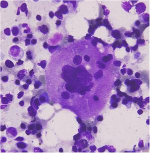 Bone marrow aspirate showing a megakaryocyte with engulfed neutrophils and lymphocytes; Geimsa stain, 1000×.