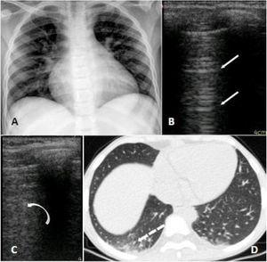 Panel A (radiograph): mild infiltrate peribronchial; Panel B (LUS): normal pulmonary aeration; A lines on left superior lobe. Panel C (LUS): B lines which correspond to alveolar-interstitial syndrome of right inferior lobe. Panel D (CT): peripheral small ground glass consolidations on the right inferior lobe.