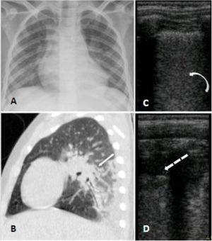Panel A (chest radiograph): retrocardiac bilateral peribronchial consolidations. Panel B (sagittal chest CT): peri bronchial patchy consolidations and ground glass consolidations on the left lung. Panel C and D (LUS): multiple B lines erasing A lines and subpleural peripheral consolidation implying alveolar-interstitial syndrome of inferior zones of both lungs.