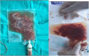 Defrosted donor stem cell product with debris.