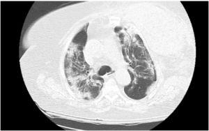CT chest angiography large left chest wall hematoma involving left breast tissue and left pectoral musculature.