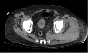 CT abdomen pelvis without contrast showing marked edema with areas of increased density involving left adductor muscle, proximal hamstring muscles, piriformis and gluteus maximus.