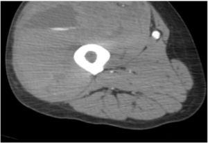 CT thigh with contrast showing large hematoma in anterior compartment of right thigh.