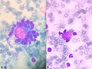 (A) Reed-Sternberg Cell. Large cell surrounded by multiple lymphocytes in a rosetting formation. (B) Hodgkin Cell. Atypical mononuclear cell flanked by some lymphocytes. Bone marrow aspirate, Leishman stain, 1000 × magnification.