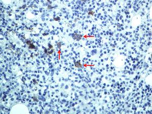 Immunohistochemistry analysis for CD30 is positive in Reed–Sternberg and Hodgkin cells (arrows). Bone marrow biopsy, 400 × magnification.