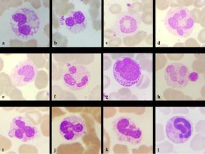 Neutrophil changes seen in the patient- intracytoplasmic vacuoles (a), pseudo-Pelger-Huet nuclei (b), ring (c), clubbed (d), monolobated (e), drumstick with platelet satellitism (f), myeloid precursor (g), hypo granulation with giant platelet (h), tripolar (i), "U" shape (j), fetus like (k), elongated nucleoplasm (l) (Leishman stain, x100)