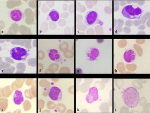 Lymphocyte morphological changes seen in the patient- normal small lymphocyte (a), cytoplasmic outpouching (b), cytoplasmic pod (c), plasmacytoid lymphocyte with cytoplasmic vacuoles (d), in-folding of nucleus (e), nuclear blebs with platelet satellitism (f,g), multiple blebs/baby feat (h), nuclear lobations (i), irregular nuclear membrane with platelet satellitism (j), cytoplasmic pod and granularity (k), large lymphocyte with increased granularity (l) (Leishman stain, x100)