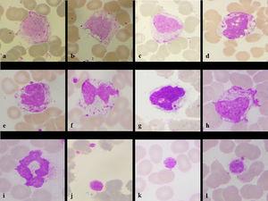 Monocyte showing irregular cytoplasm outline (a), cytoplasmic vacuolation (b), nuclear bleb (c), intracytoplasmic and intranuclear vacuolation (d), horse shoe nuclei (e), bilobed and platelet satellitism (f), engulfed platelet (g), increased cytoplasmic granularity (h), ring shaped smudge cells (i), and platelet changes in form of giant platelets (k) and platelet adhesion (l). (Leishman stain, x100)