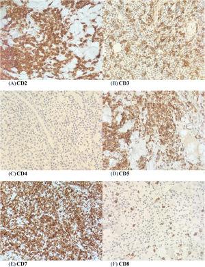 (A-F) A panel of immunohistochemical staining (x 40 magnifications) shows positivity for CD2, CD3, CD5 and CD7. Neoplastic cells show negativity for CD4 and CD8.