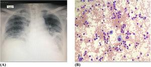 (A) Chest radiograph shows left pleural effusion with left lung atelectasis (B) Pleural fluid morphology shows scattered mesothelial cells with abnormal lymphoid cells.