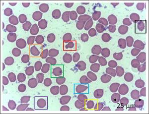 Slide from a critically ill patient with COVID-19 admitted to an intensive care unit of a hospital. The slide details evidence of morphological alterations in red blood cells by the SARS-CoV-2 infection: red - mushroom red blood cells; green - red blood cells with the presence of Heinz bodies; blue - dacryocytes; purple - spherocytes; yellow - echinocytes (plasmolysis), and; black - acanthocytes; orange - keratocytes (bite cell). Staining method: Leishman. Magnification: 400X. Credits: Dr. Denise da Silva Pinheiro - LACES-ICB UFG.