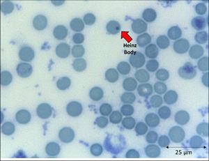 Slide highlighting Heinz bodies from a critically ill patient with COVID-19 admitted to an intensive care unit of a hospital. Staining method: Brilliant Cresyl Blue. Magnification: 400X. Credits: Dr. Denise da Silva Pinheiro - LACES-ICB UFG.