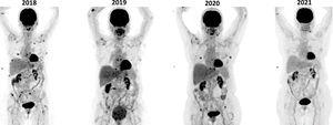 PET CT revealed avid stage IV disease in breast and bone lesions in 2018, 2019 and 2020 and no uptake in 2021 even with no specific treatment for the lymphoma.