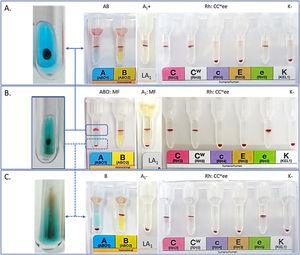 Mixed Field Resolution In Abo Phenotyping In A Rare Case Of A Blood 