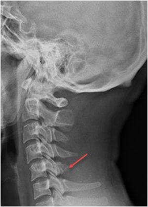 Radiografia columna cervical.