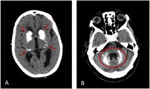 Brain CT: bilateral basal ganglia calcifications.