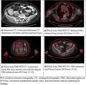 Recurrent colorectal carcinoma presenting with ileus due to small bowel metastases: A case report