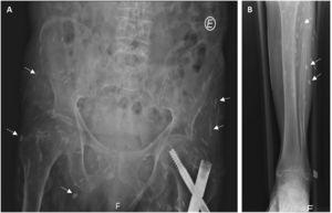 (Abdominal radiograph) and Figure B (Right Leg radiograph), both showing oval-shaped calcifications (cysticercus;).