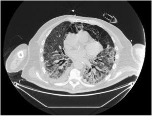 CT chest (transverse view) of a pneumomediastinum in a 78-year-old male patient, Covid-19 positive, intubated.
