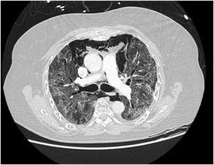 CT chest (transverse view) of a spontaneous pneumomediastinum in a 48-year-old female patient, Covid-19 positive.