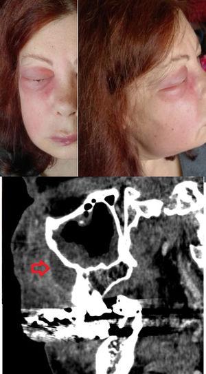 Existe progresión del edema y de los signos inflamatorios locales, sobre todo a nivel palpebral, dado que la piel de los párpados es muy fina y elástica. La flecha roja marca la localización del absceso odontógeno en la tomografía computarizada.