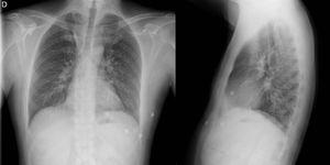 Radiografía de tórax al ingreso con afectación intersticial reticular en campos medios indicativa de neumonitis.